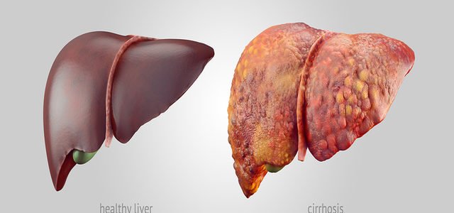 Psoriasis Of The Liver Alcohol
