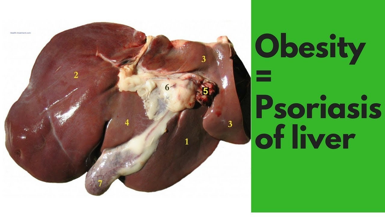 Psoriasis Of The Liver