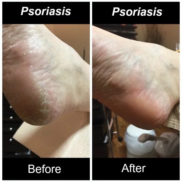 Psoriasis  Often Confused with Athletes Foot