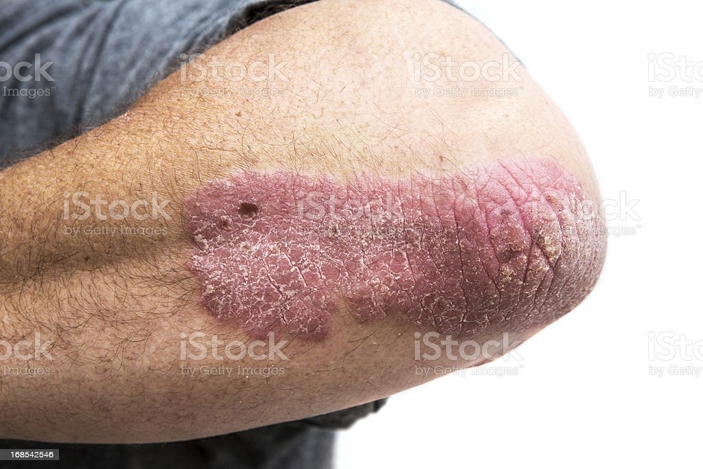 Psoriasis On A Mid Age Mans Elbow stock photo 168542546 ...