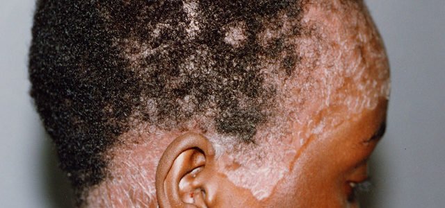 Psoriasis On African American Scalp