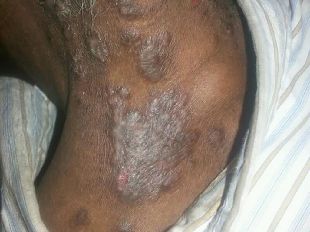 Psoriasis on black skin: Treatment, symptoms, and pictures