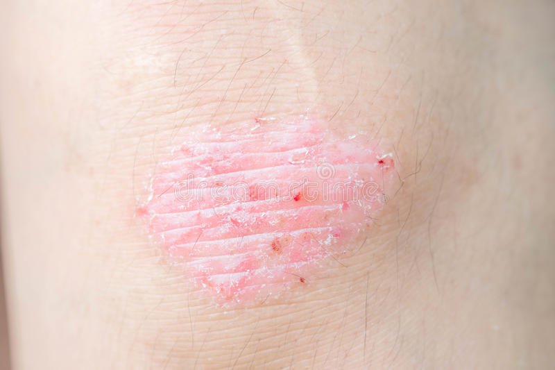 Psoriasis on elbow stock image. Image of itching, eczema ...