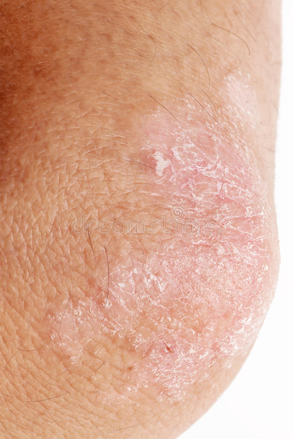 Psoriasis on elbow stock image. Image of peeling ...