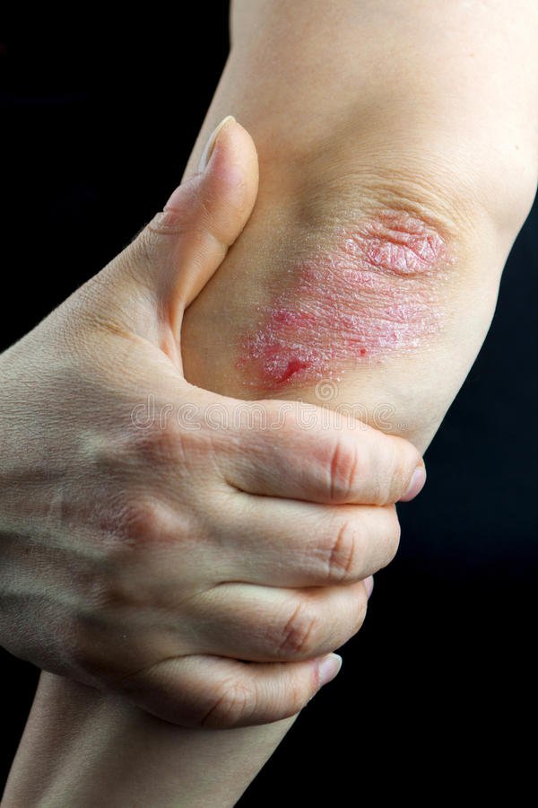 Psoriasis on elbows stock photo. Image of dermatology ...