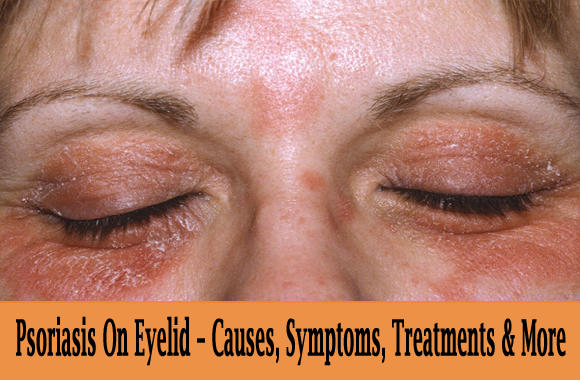 Psoriasis On Eyelid  Causes, Symptoms, Treatments &  More ...