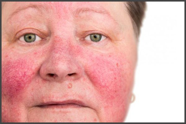 Psoriasis on face pictures