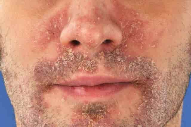 Psoriasis on Face