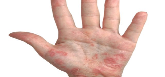 Psoriasis On Hands And Feet Only