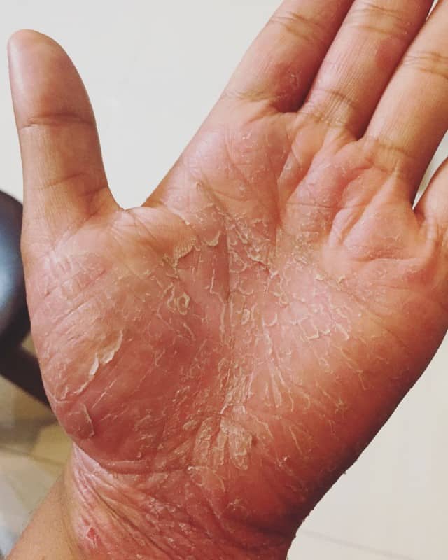 Psoriasis on Hands and Feet Why and How to Prevent It?