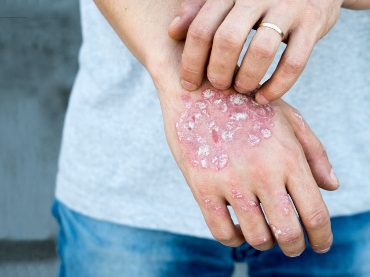 Psoriasis on Hands: Causes and Treatment