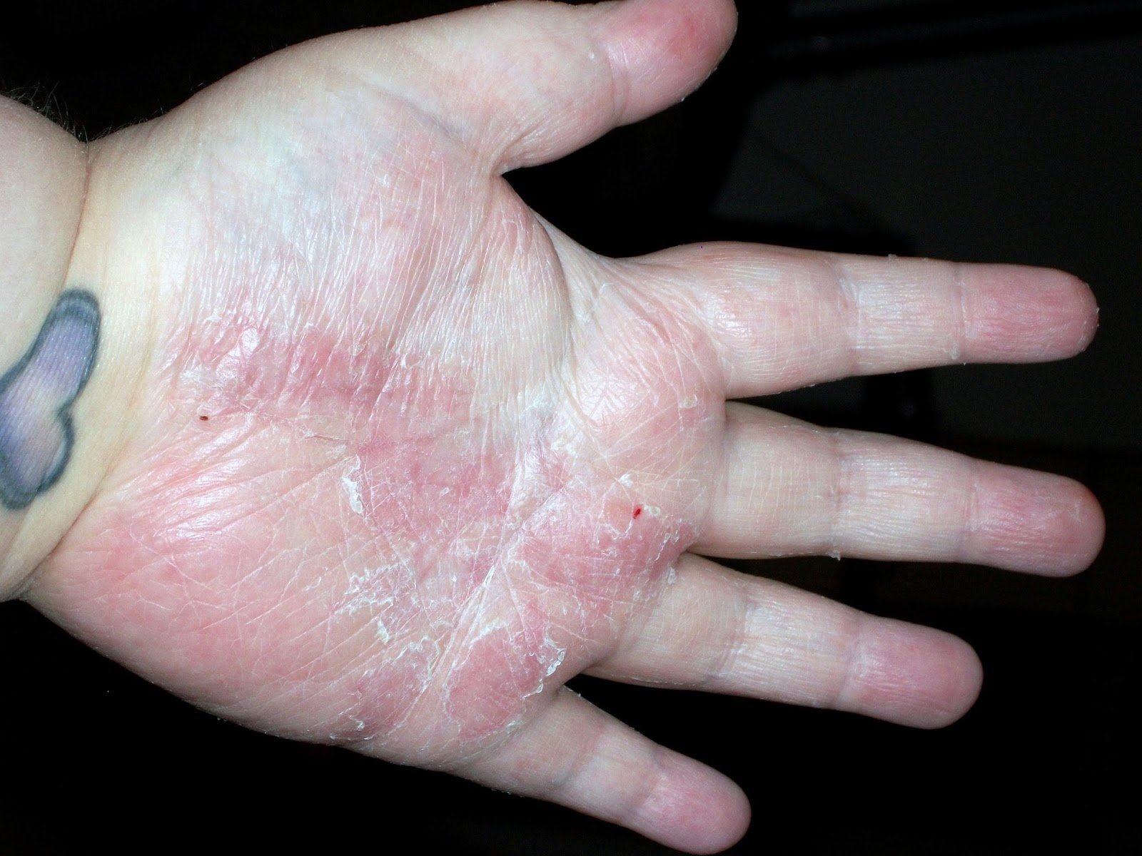 psoriasis on hands