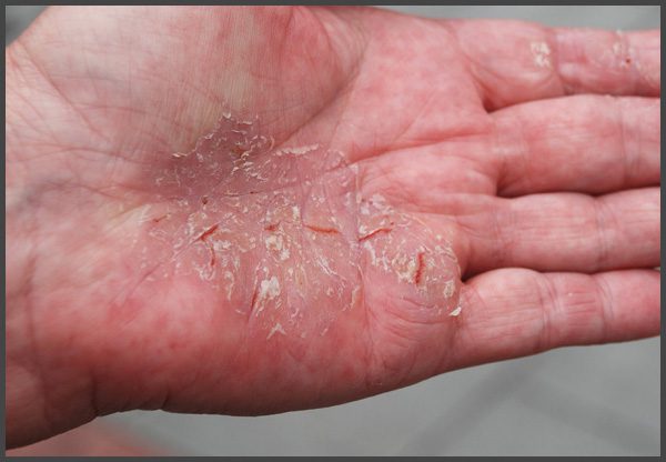 Psoriasis on hands pictures