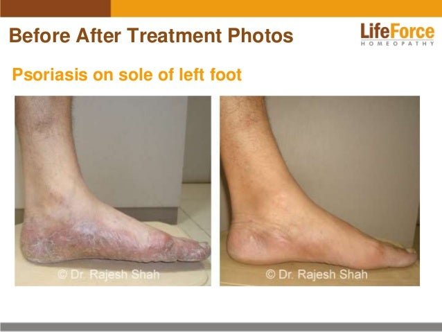 Psoriasis on Legs Photos: Before After Treatment Pictures of Patientsâ¦