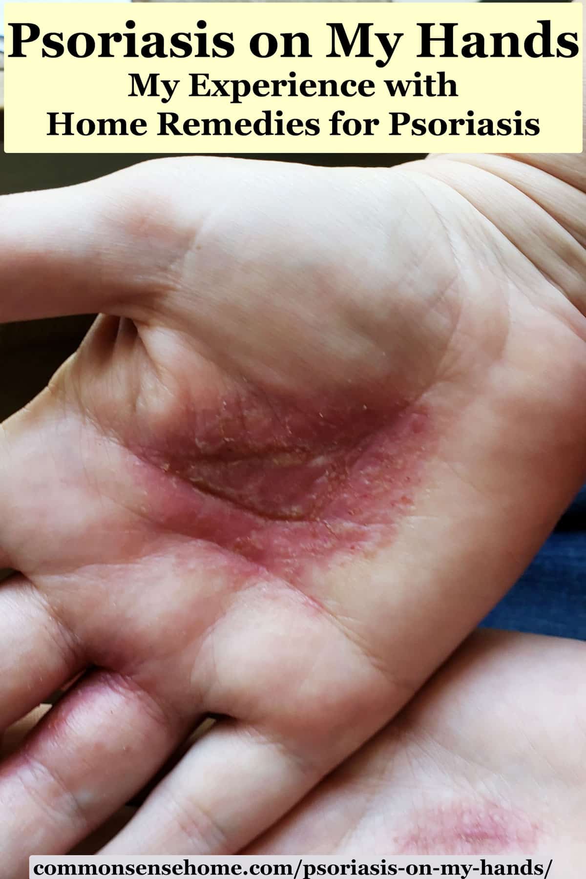 Psoriasis on My Hands