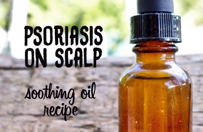 Psoriasis on Scalp: Try this Soothing &  Moisturizing DIY ...