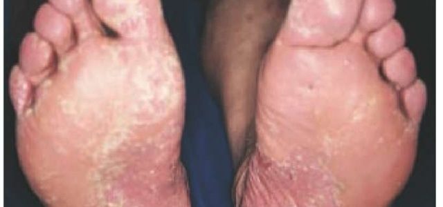 Psoriasis On Soles Of Feet Images