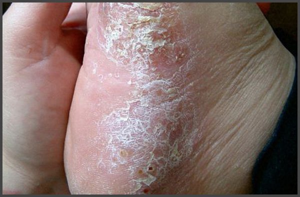 psoriasis on soles of feet pictures