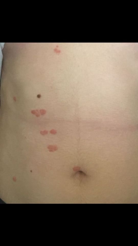 psoriasis on stomach may2017 On CureZone Image Gallery