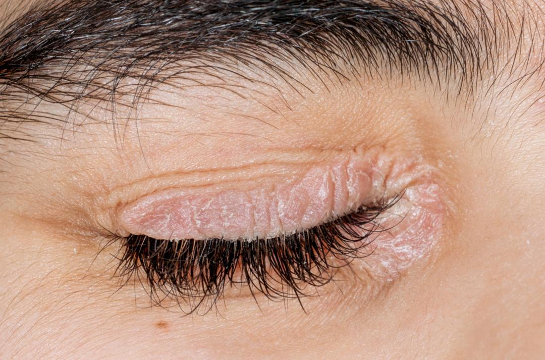 Psoriasis on the eyelids: Symptoms, causes, and treatment
