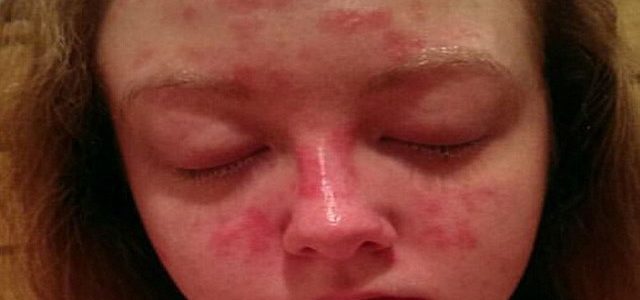 Psoriasis On The Face
