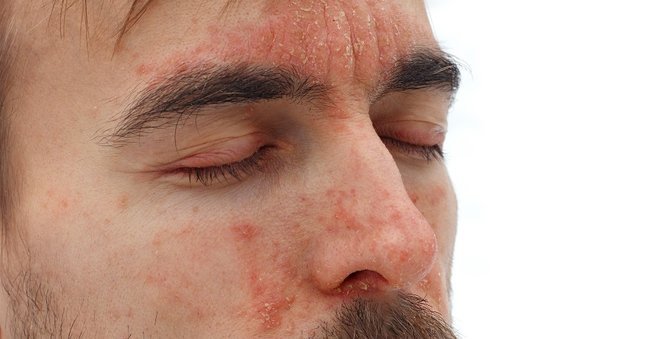 Psoriasis on the Face