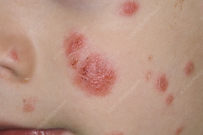 Psoriasis on the face