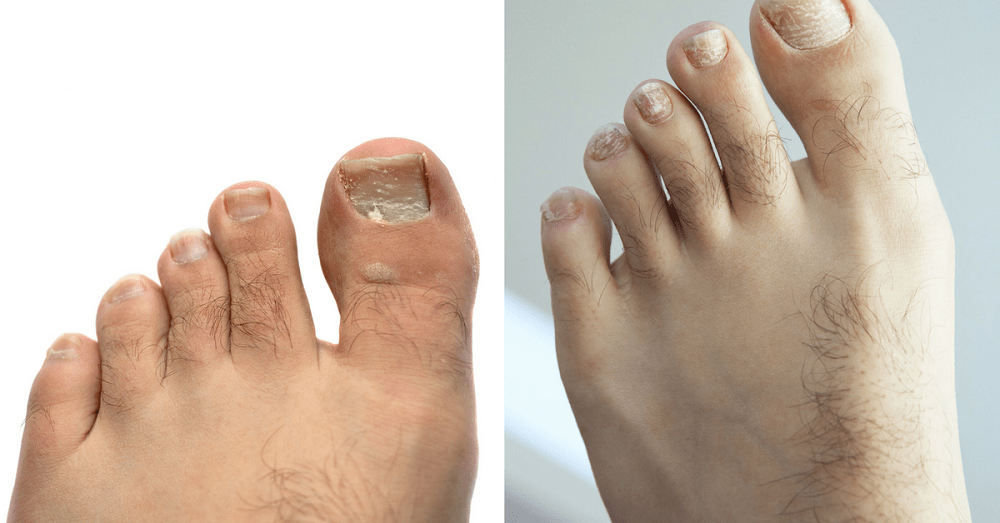 Psoriasis on the Feet: Why is it so Important to Treat it ...
