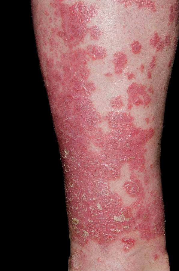 Psoriasis On The Leg Photograph by Dr P. Marazzi/science ...