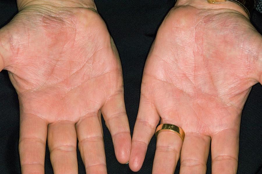 Psoriasis On The Palm Of The Hands Photograph by Dr P. Marazzi/science ...