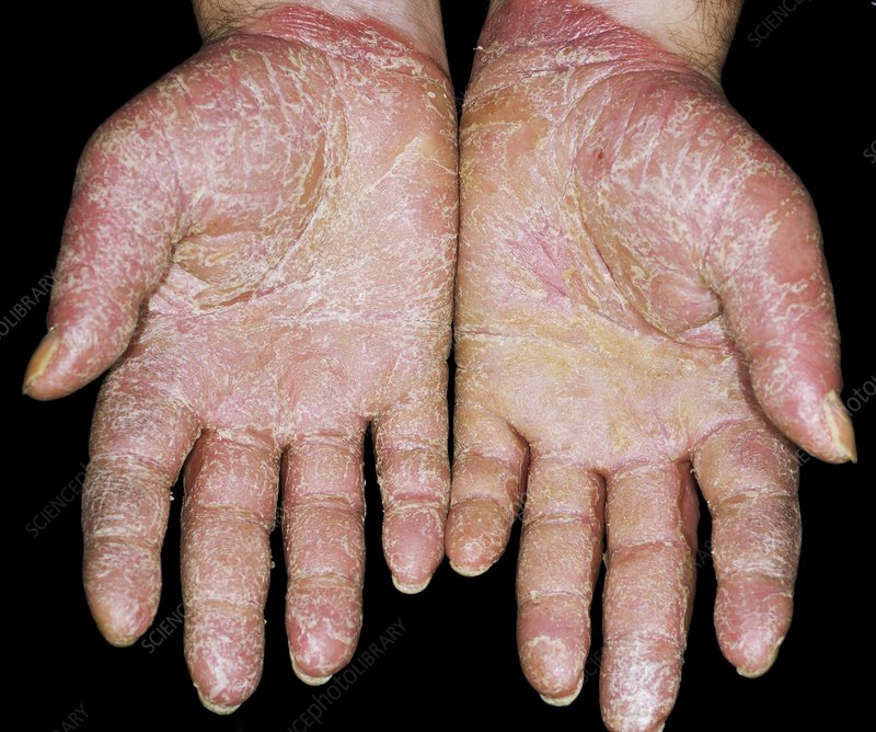 Psoriasis on the palms of the hands
