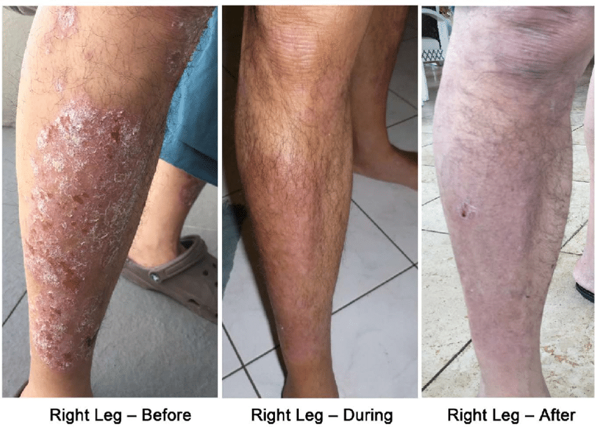Psoriasis on the right leg before, during (2 weeks) and ...