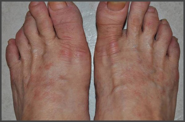 psoriasis on top of feet pictures
