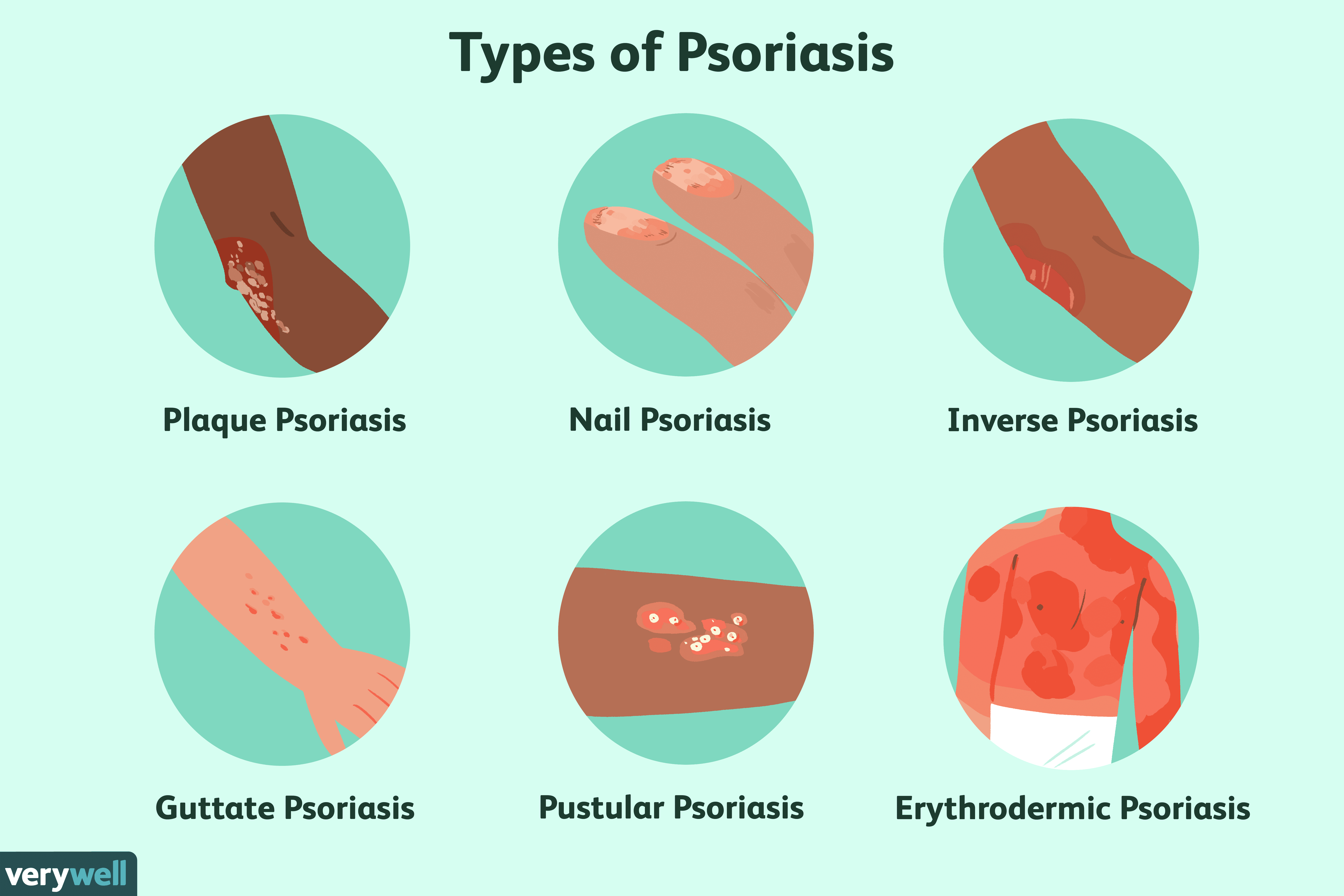 Psoriasis: Overview and More