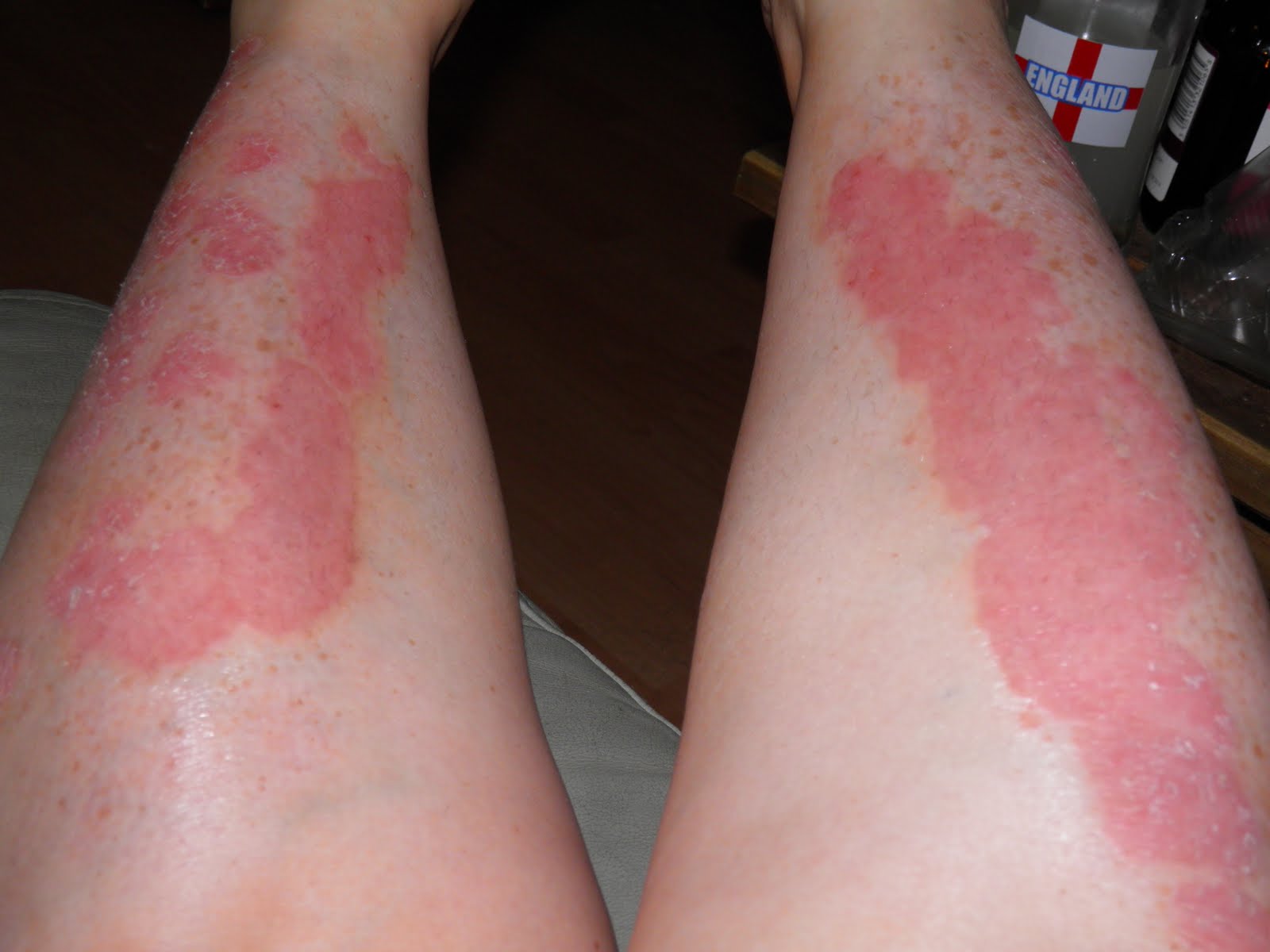 Psoriasis Patches on Legs