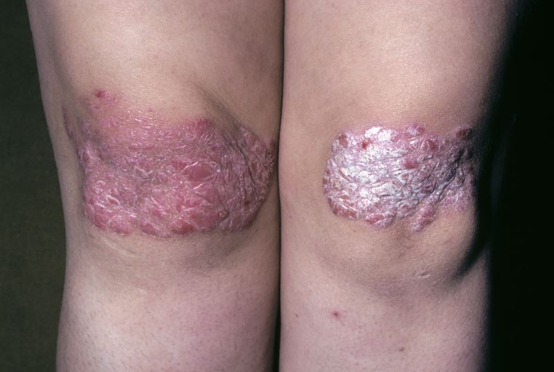 Psoriasis Patients Deemed Ineligible for Clinical Trials Often Have ...