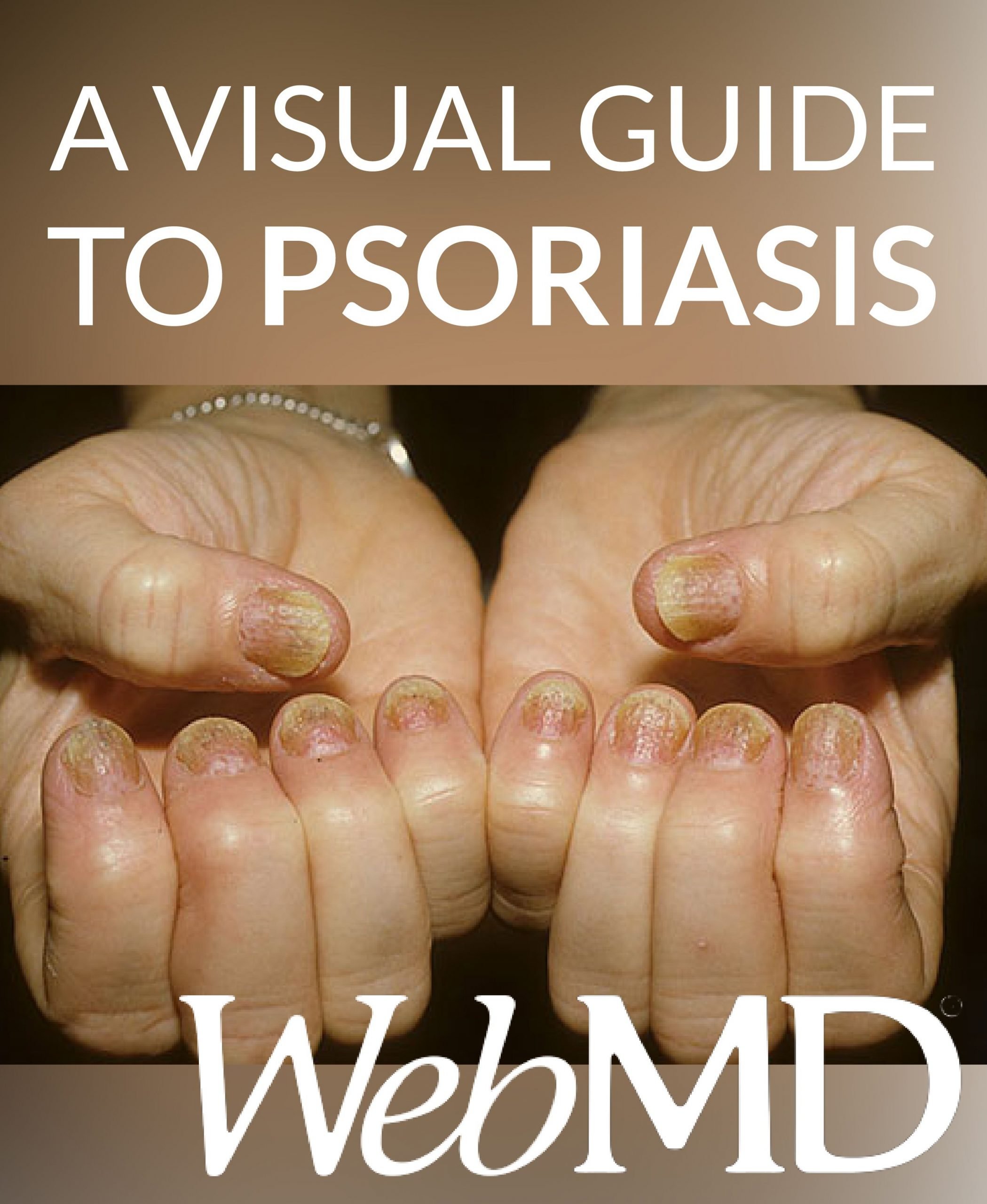Psoriasis Pictures: A Visual Guide To Psoriasis on Skin, Nails, and ...