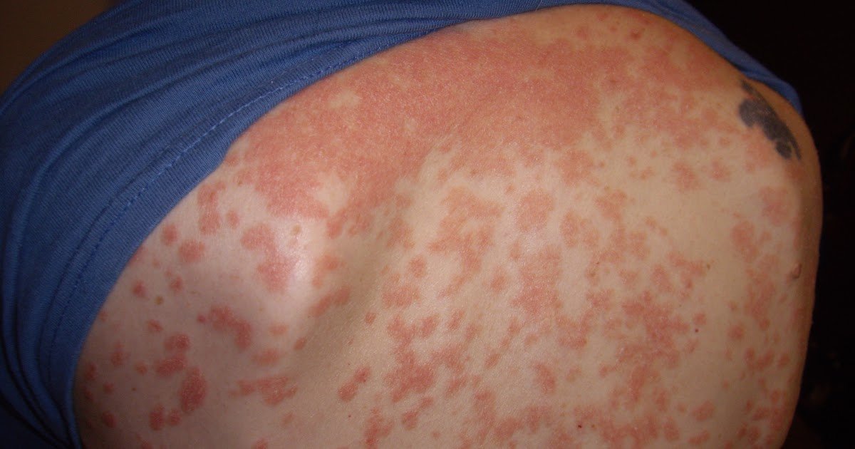 Psoriasis Pictures: Identifying Your Rash