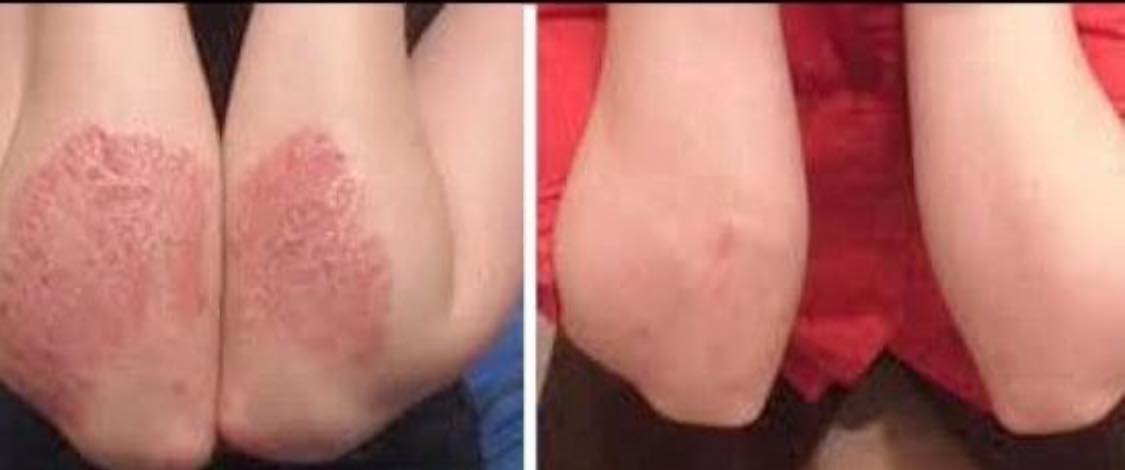 Psoriasis Pictures on Arms