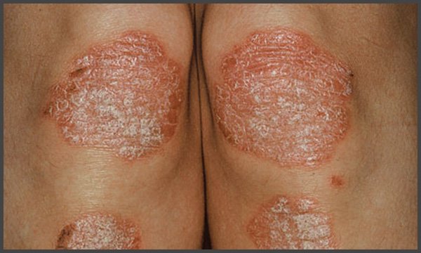 Psoriasis pictures on knees