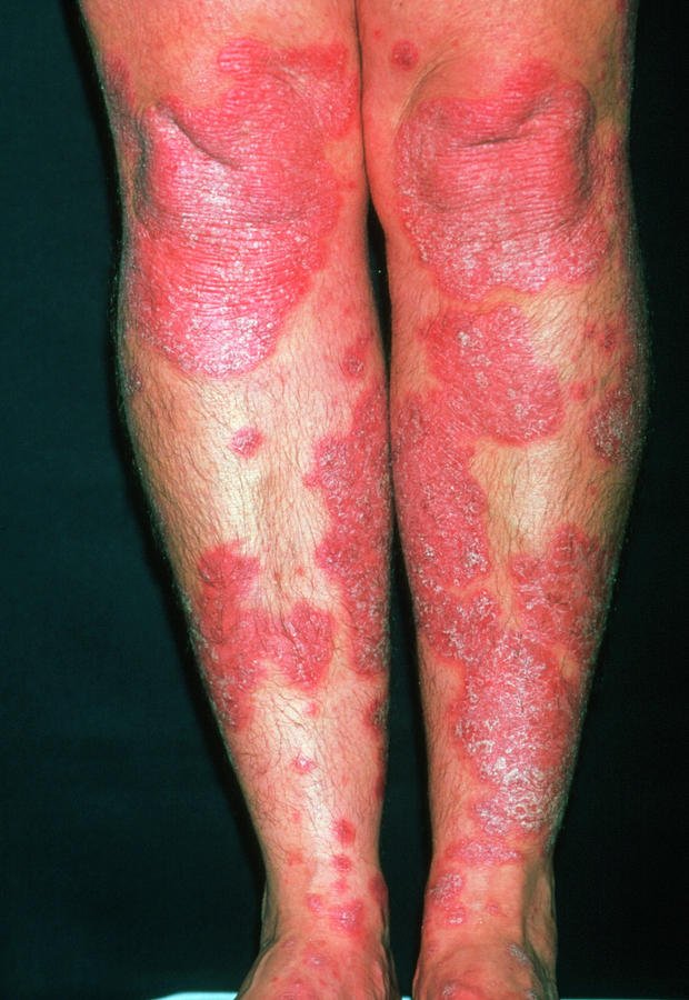 Psoriasis Pictures On Leg