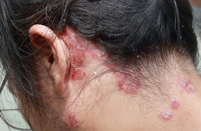 Psoriasis, Psoriatic Arthritis, and Hair Loss: Causes and Treatments