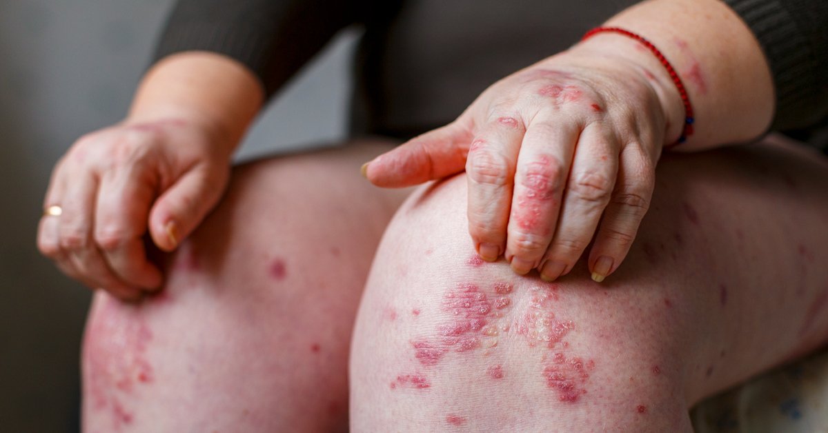 Psoriasis Rash: Pictures, Causes, Symptoms, and Treatment