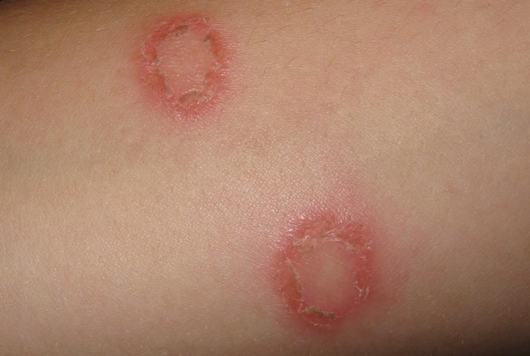Psoriasis rash: Types, pictures, and symptoms