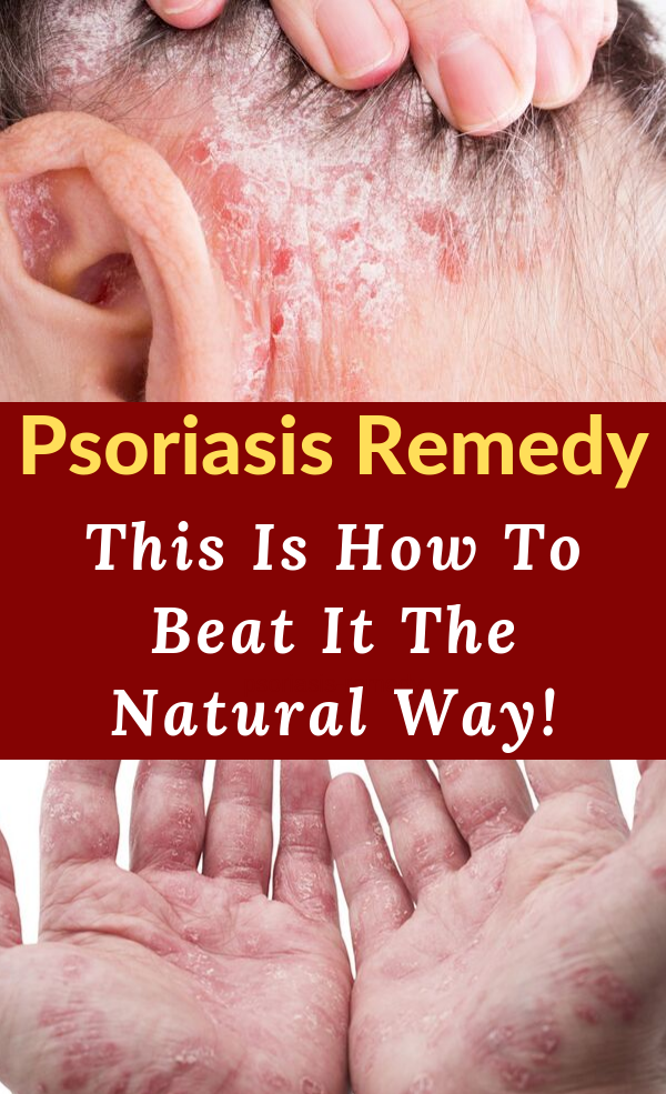 Psoriasis Remedy