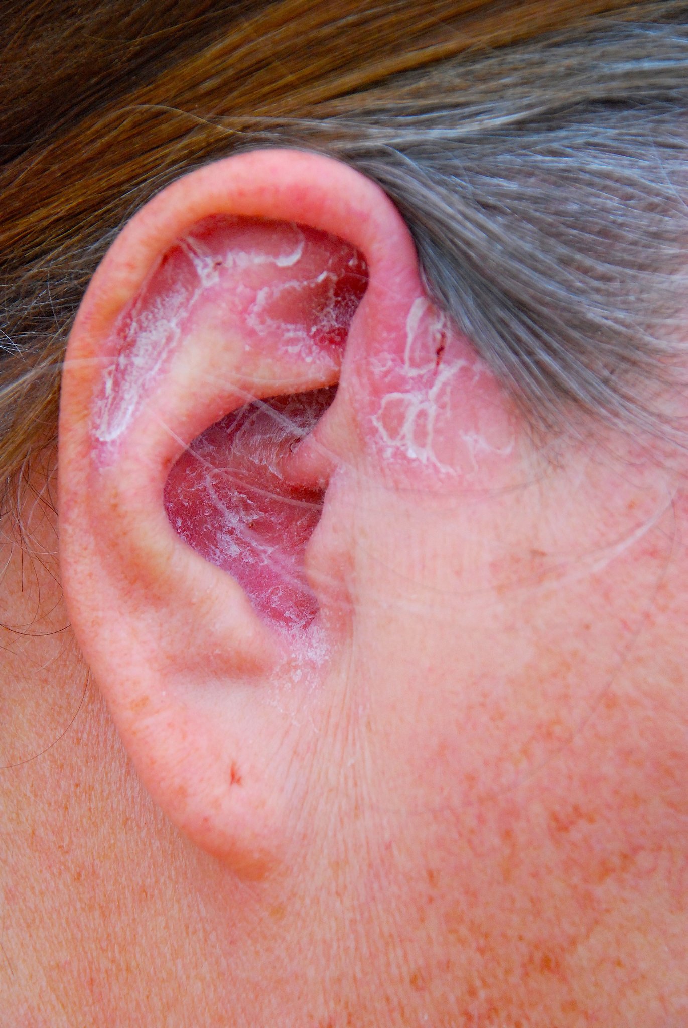 psoriasis scalp behind ears