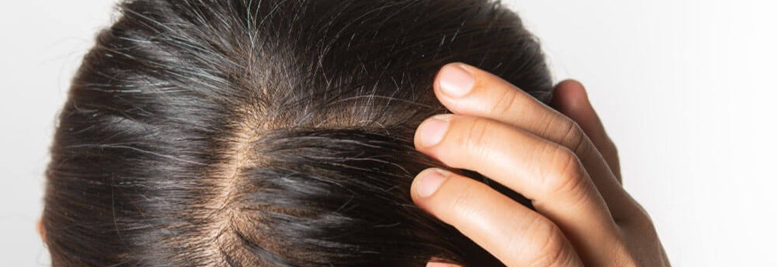 Psoriasis Scalp : What Is Scalp Psoriasis Causes Symptoms And More L ...