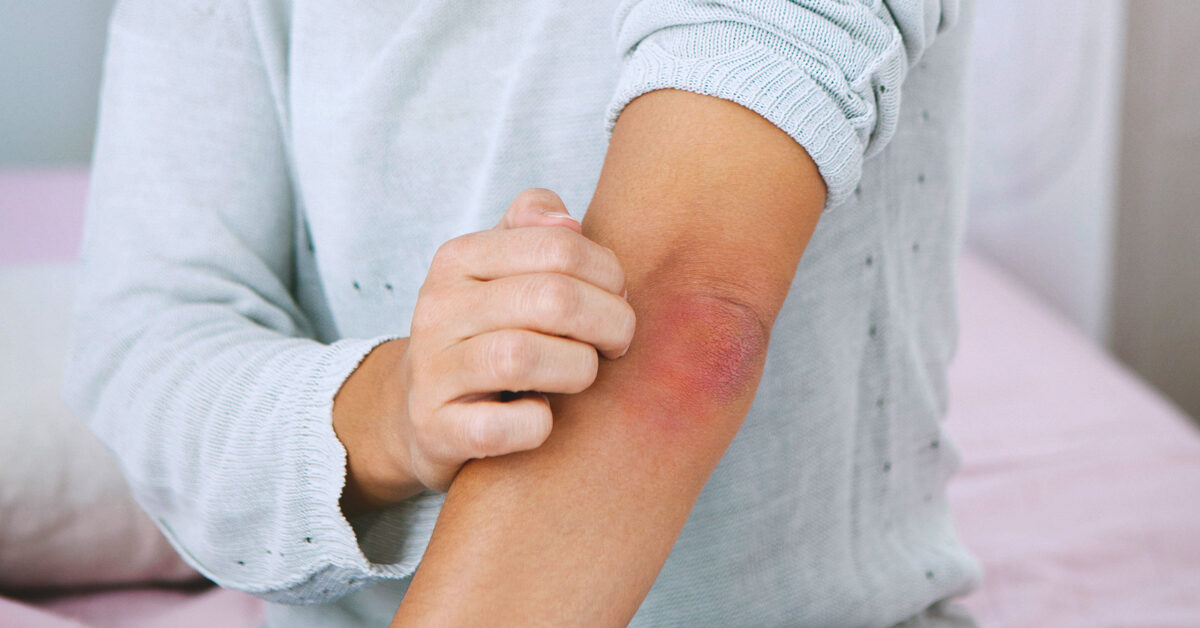 Psoriasis Scar Treatment: Know Your Options