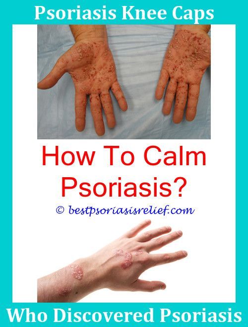 Psoriasis Shampoo Australia,psoriasisvseczema how to cover ...