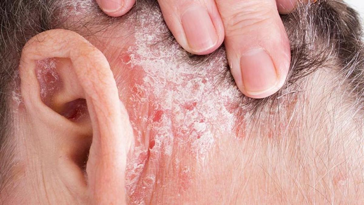 Psoriasis: Síntomas, causas y cómo tratar esta enfermedad de la piel
